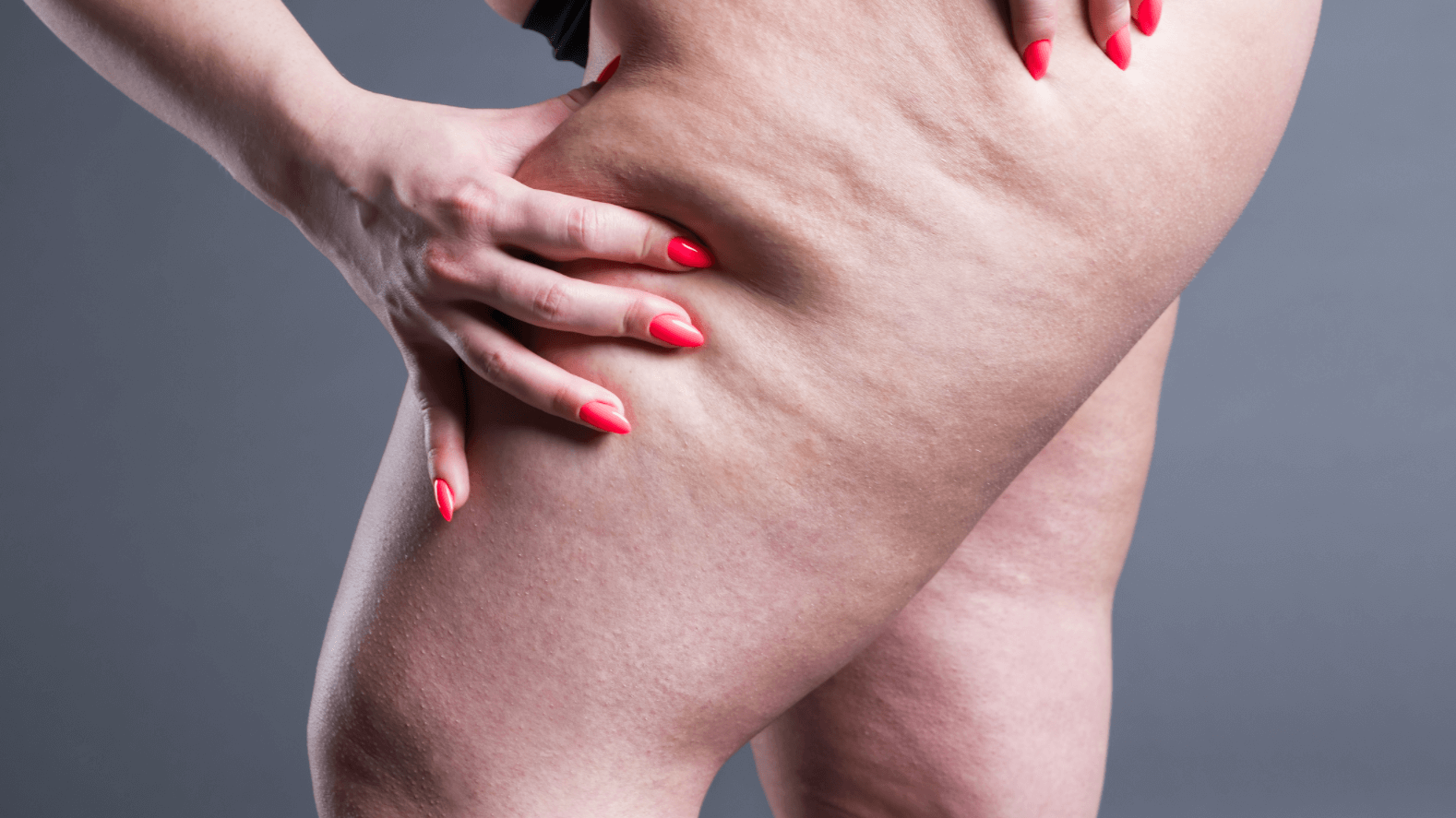 Does CoolSculpting® Reduce Cellulite?