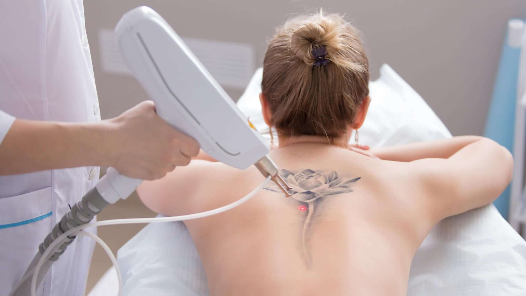 The Reasons Why People Decide to Get Their Tattoos Removed